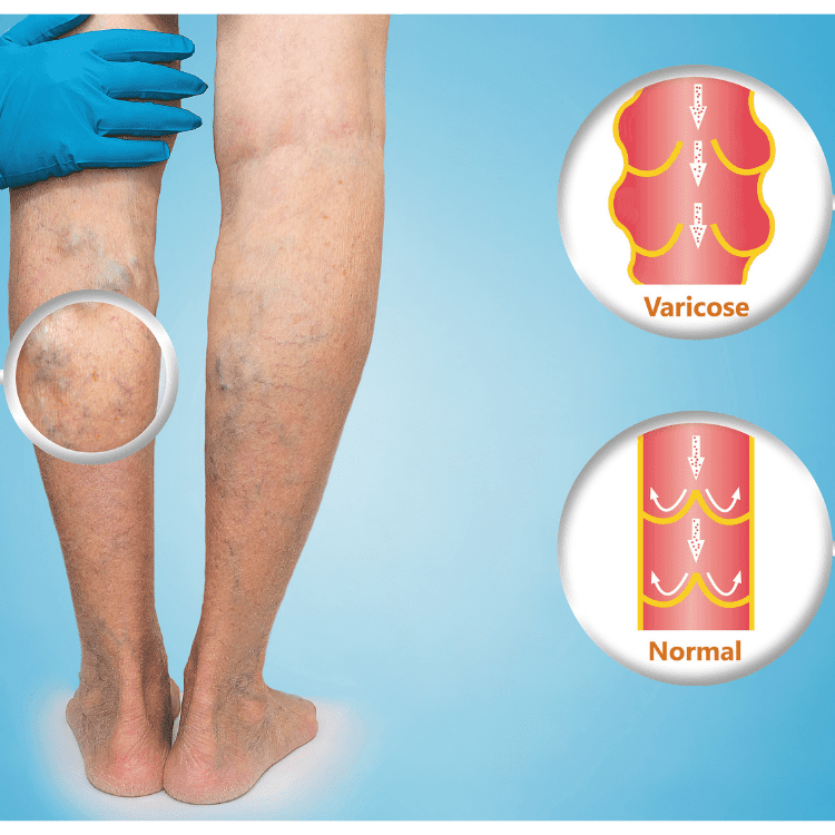Vene Varicose: Le Creme come Alleate per Combatterle